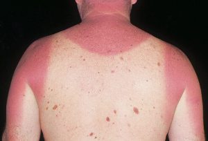 acute sunburn